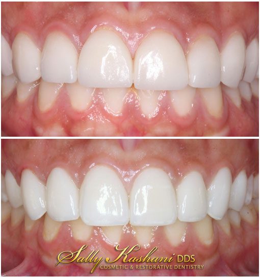 Teeth Whitening Trays