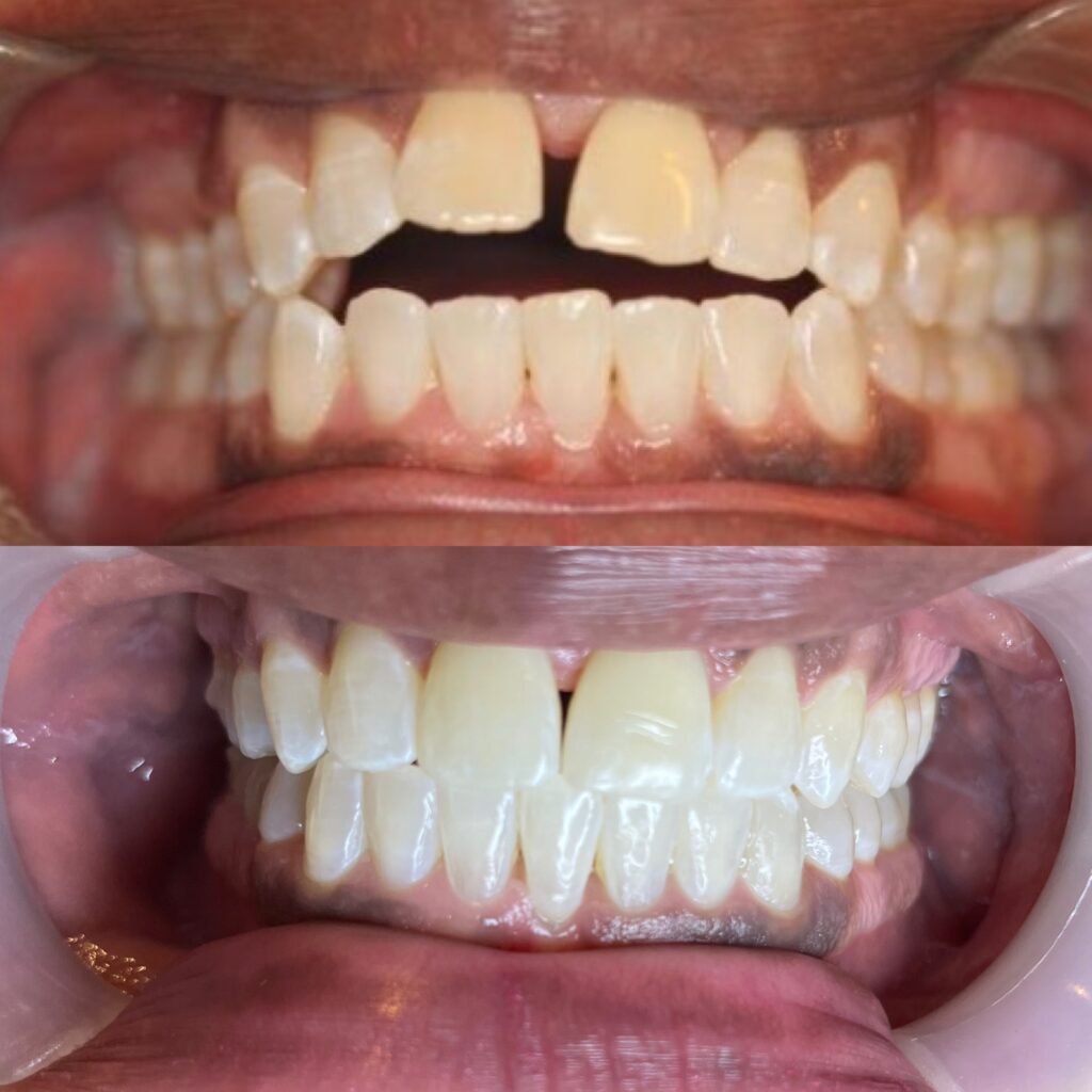Dentist in North Hollywood 2 Before and after
