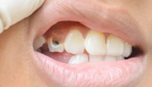 Blog 7 Peptides in dentistry