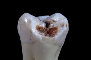 Tooth decay treatment